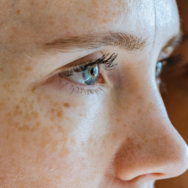 HYPER-PIGMENTATION