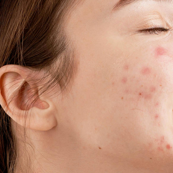 SEVERE ACNE