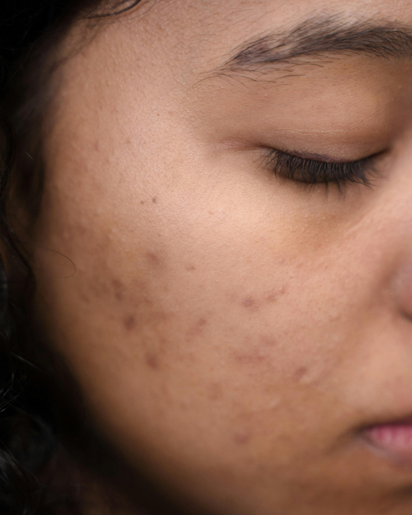 DARK SPOTS